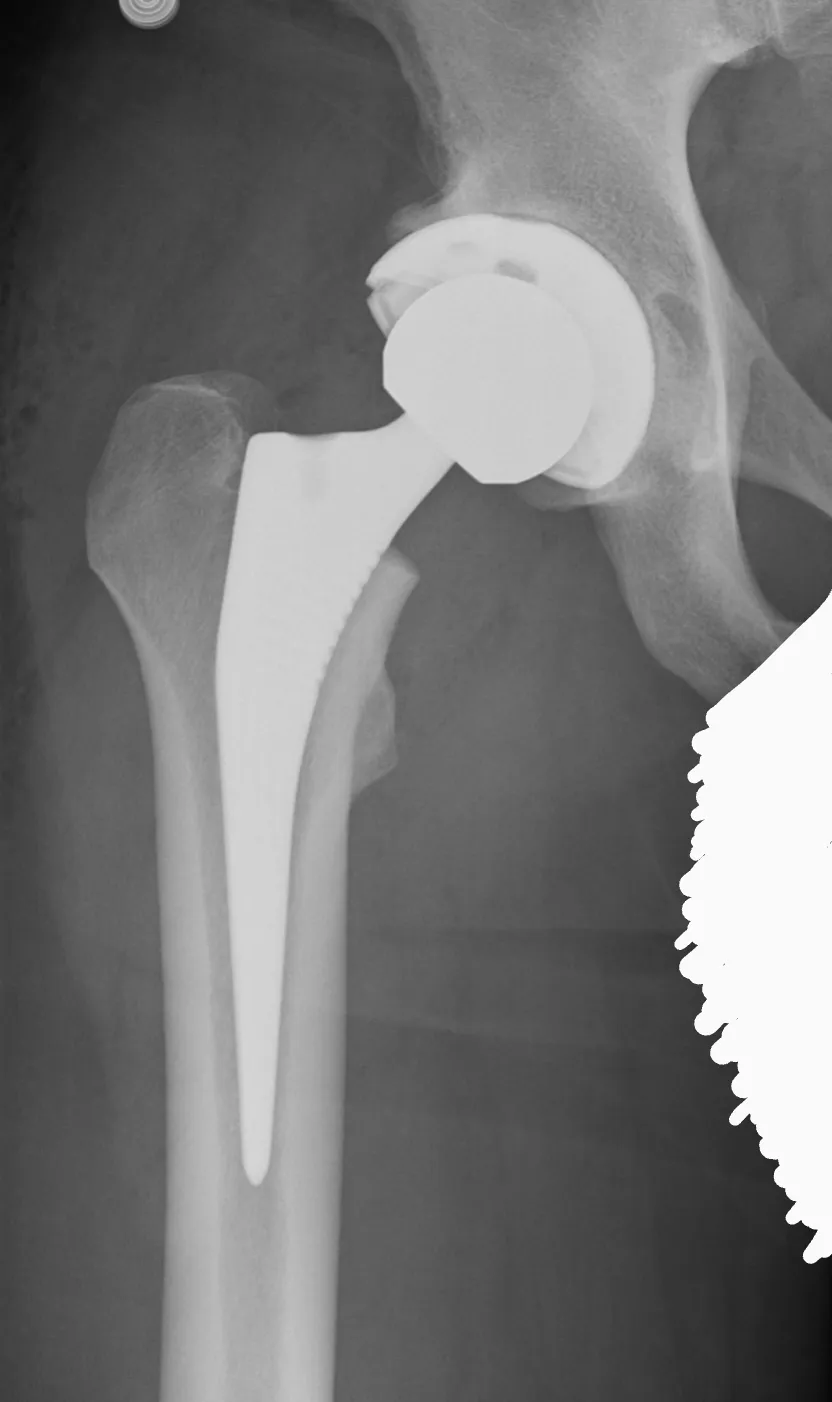 X-ray of Andrew’s operated hip showing the new implant: a metal stem in the thigh bone, a round head and a cup in the socket