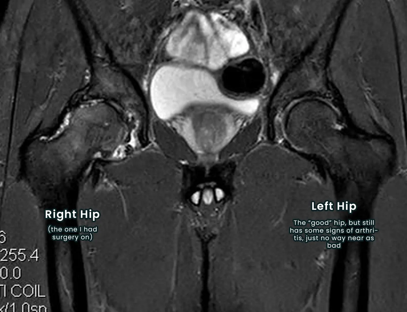 MRI scan of Andrew’s hips before surgery, labelled right hip (the one operated on) and left hip (the ‘good’ hip, with milder arthritis)