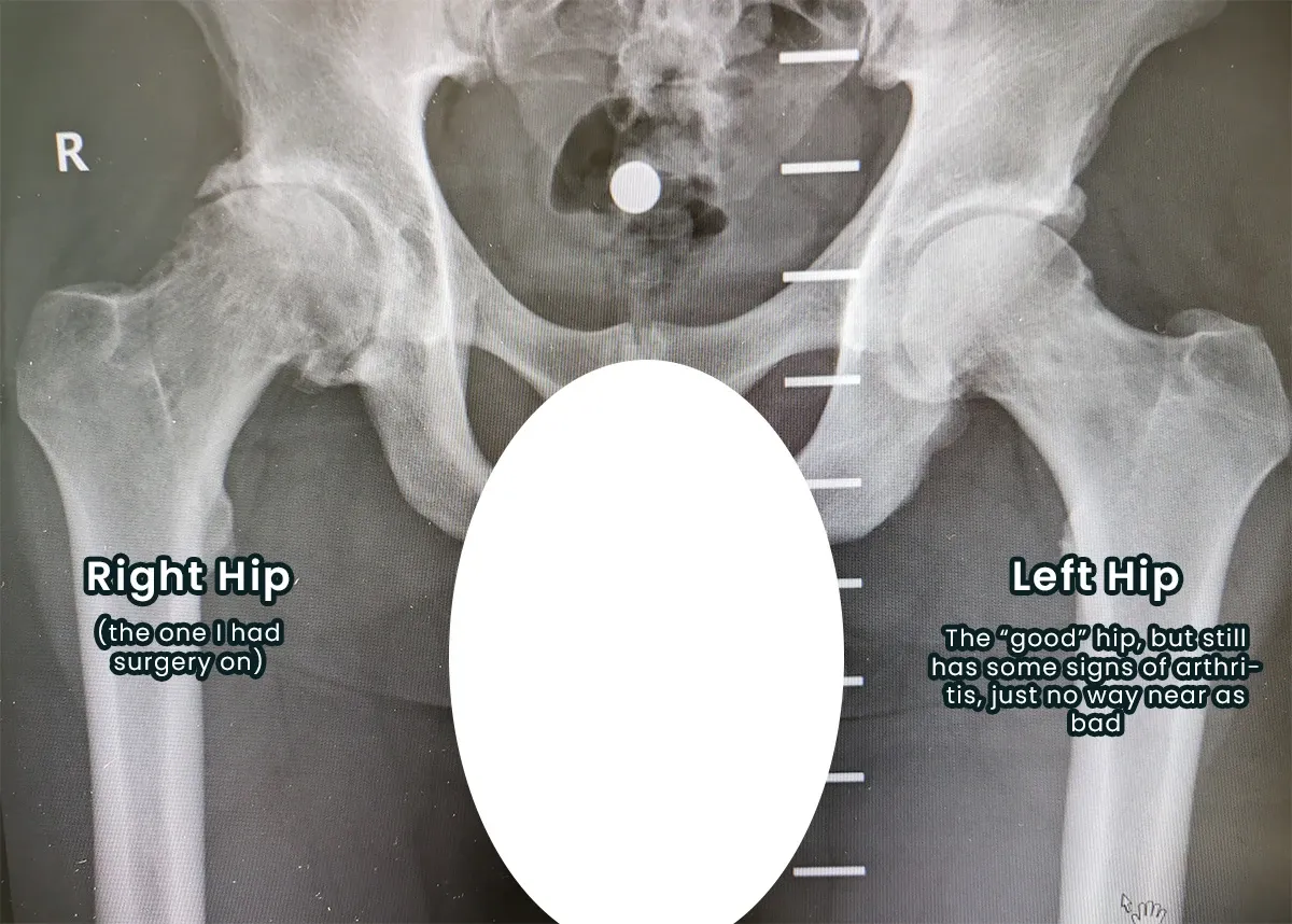 January 2024 X-ray of Andrew’s pelvis, labelled: the right hip (operated on) shows a misshapen joint with little joint space; the left ‘good’ hip shows milder signs of arthritis